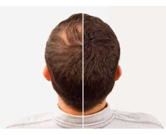 Caboki Hair Building Fiber Black - 25gCaboki Hair Building Fiber Black - 25gCaboki Hair Building Fiber Black - 25g