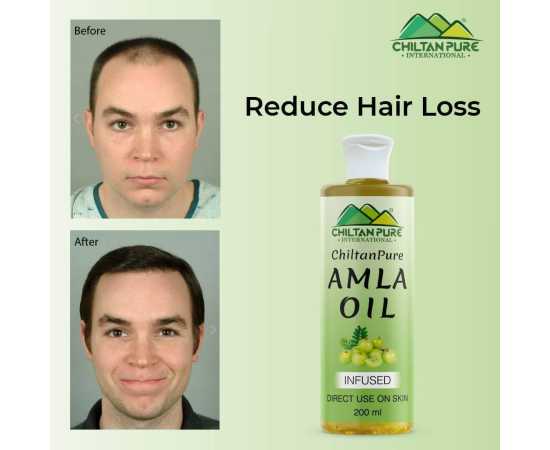 Chiltan Pure Amla Oil - Boosts Hair Growth