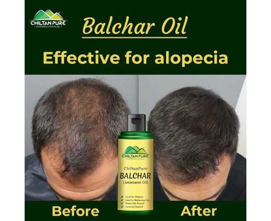 Chiltan Pure Balchar (Jatamansi) Oil For Reduces Hair Fall