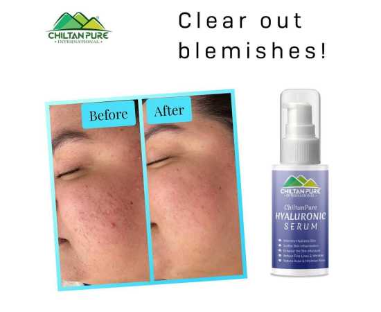 Chiltan Pure Hyaluronic Acid Serum Treats Wrinkles & Acne - 50ML