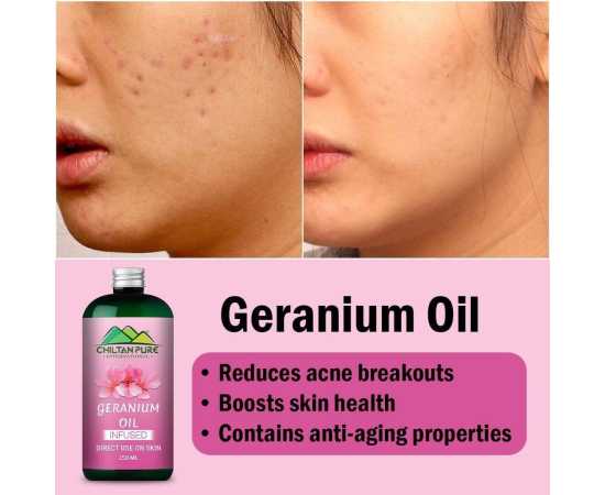 Geranium Oil - Reduces Acne Breakouts & Cure Skin Infections