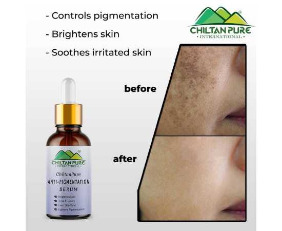 Chiltan Pure Anti-Pigmentation Serum For Brighten Skin - 30ML