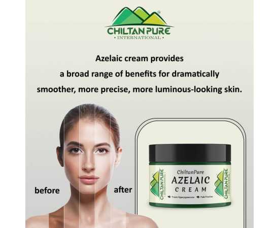 Azelaic Cream - Reduce Hyperpigmentation & Fade Acne Scars