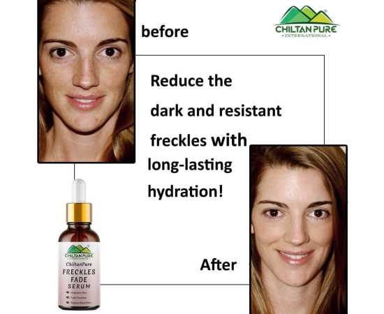 Freckles Fade Serum - Hydrates Skin & Reduce Blemishes