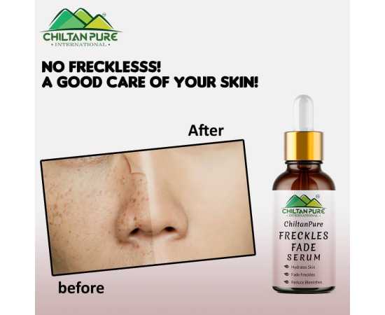 Freckles Fade Serum - Hydrates Skin & Reduce Blemishes