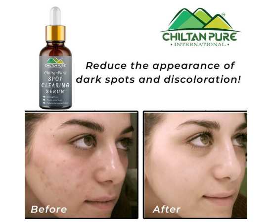 Spot Clearing Serum - Unclog Pores & Reduce Dark Spots