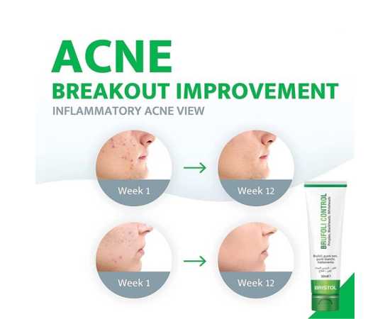 Brufoli Skin Cream For Control Blackheads & Whiteheads - 30ML