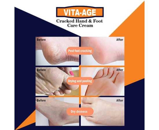 Vita-Age Cracked Hand & Foots Care Cream - 30ML