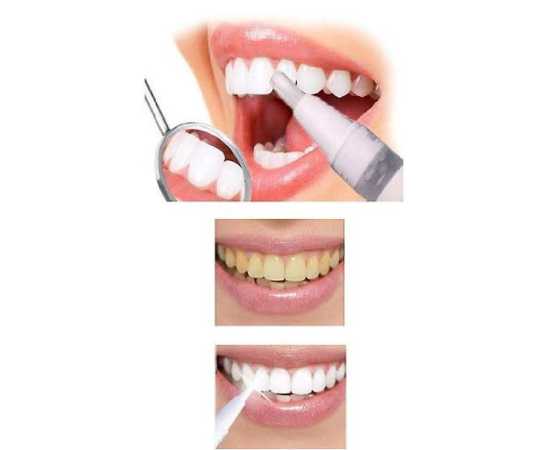 Online Karachi Teeth Whitening Pen